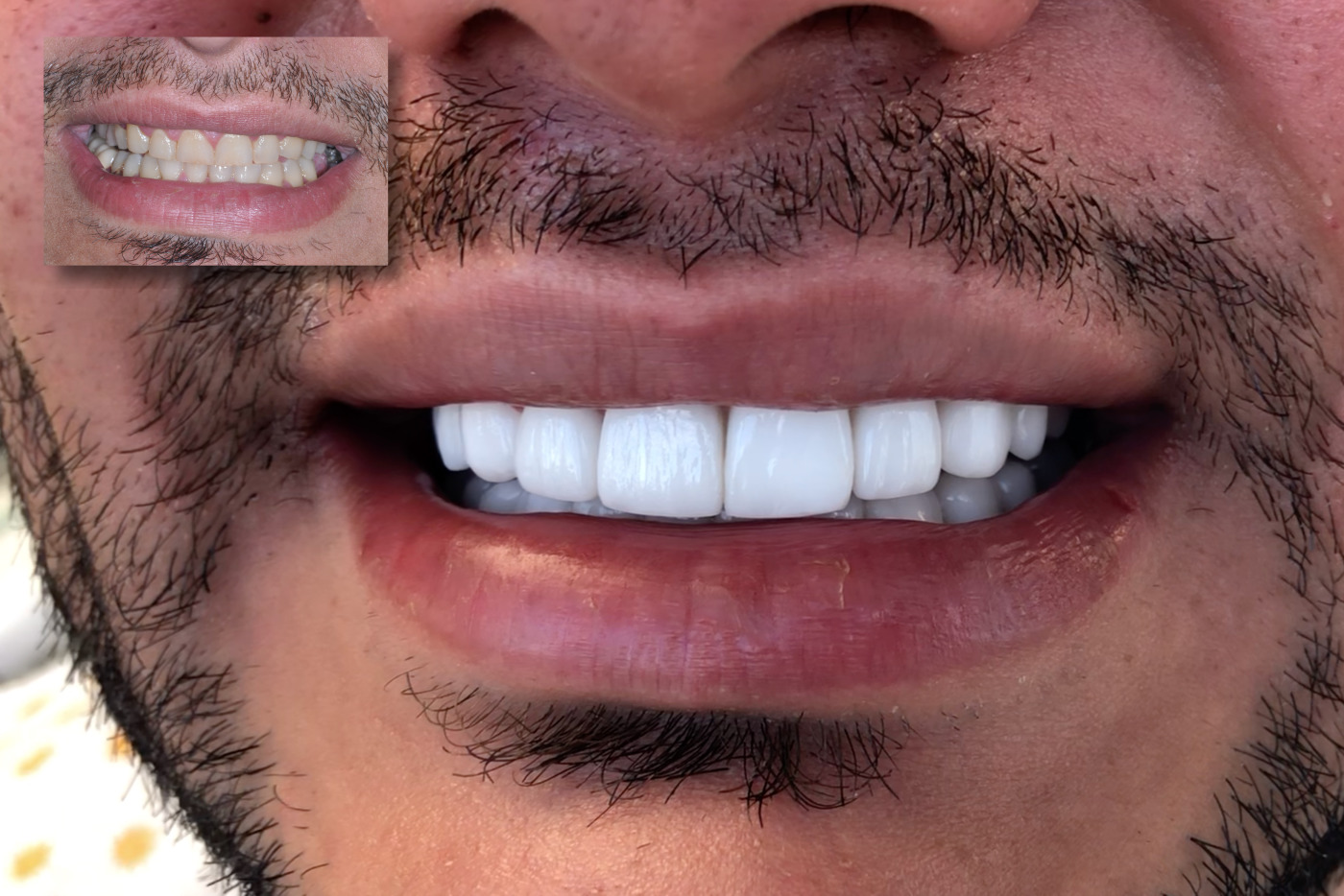 Before/After teeth ceramics