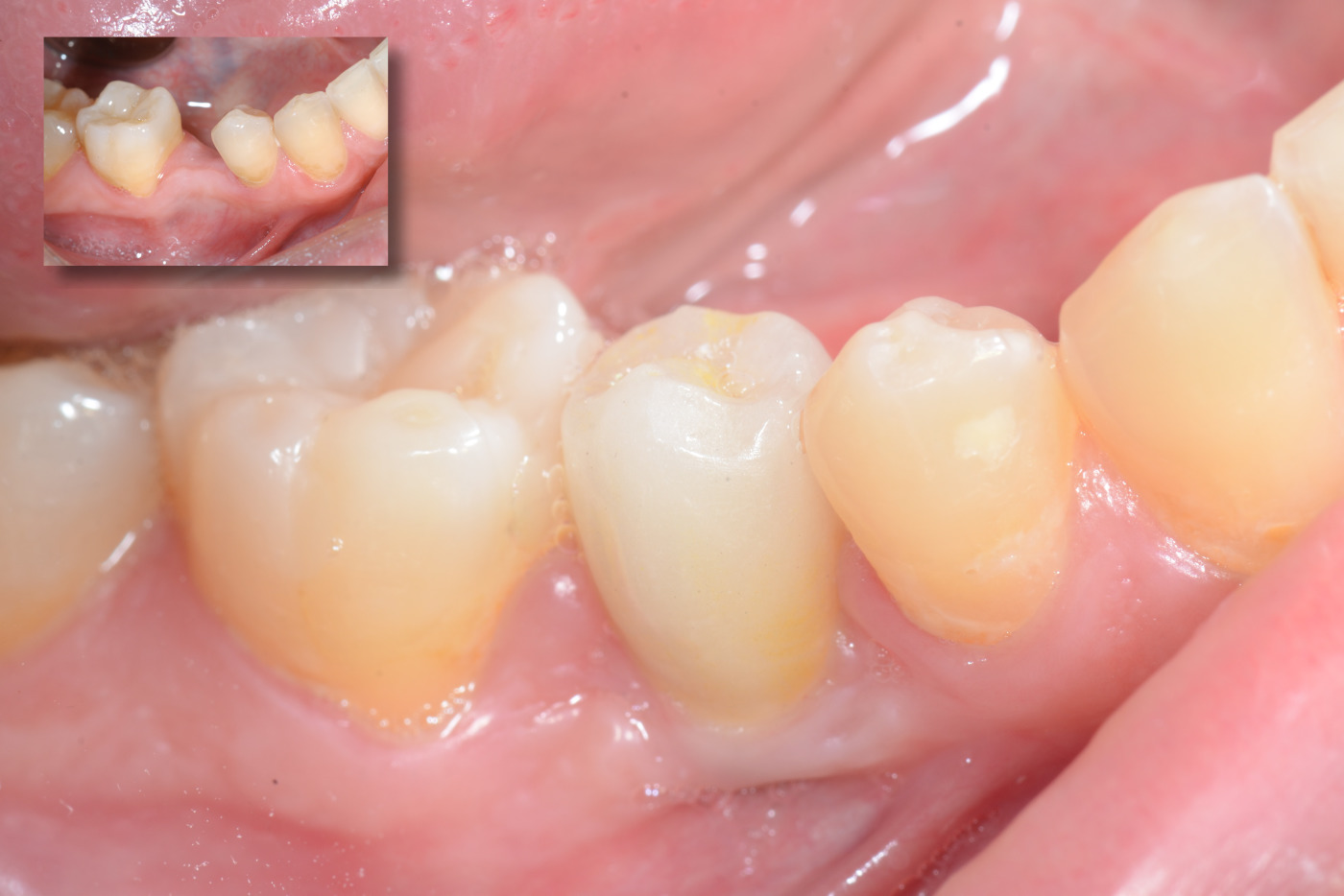 Before/After tooth implant