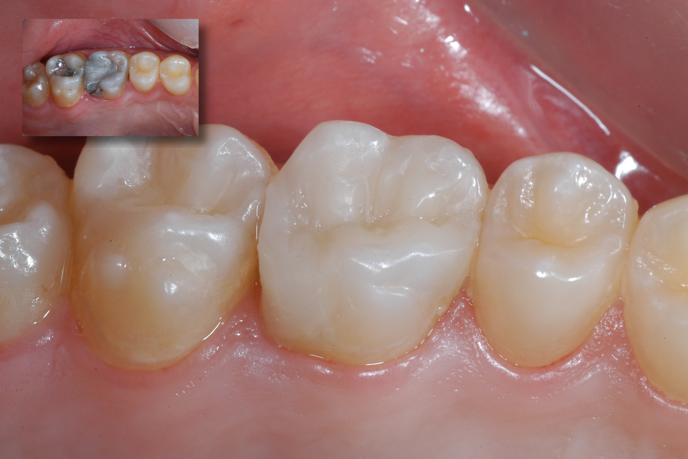 Before/After tooth restoration